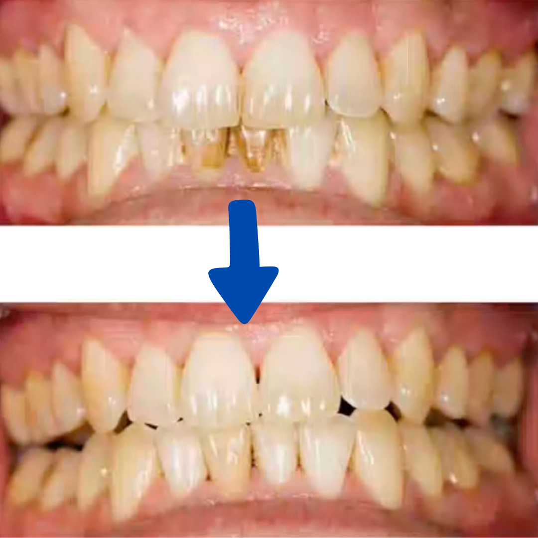 Densine™ - Sonic tooth Cleaner