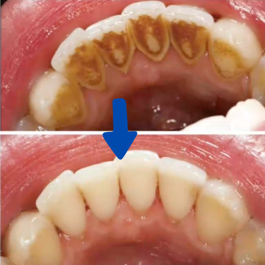 Densine™ - Sonic tooth Cleaner