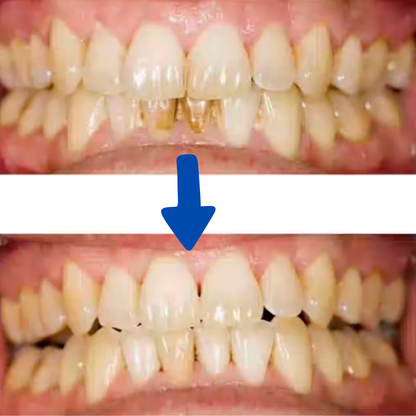 Densine™ - Sonic tooth Cleaner